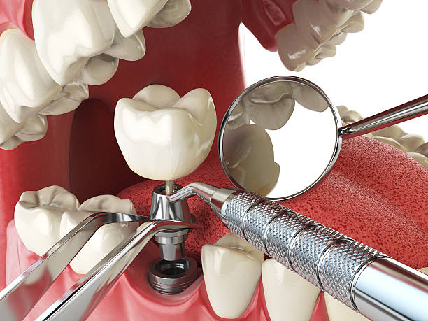 Best Emergency Denture Repair in Winfield, IA